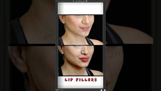 Get Fuller Symmetrical Lips By Dr Adarsh Tripathi  Sarayu Clinics fillers [upl. by Adnahcir]