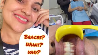 Got Self ligating Ceramic BRACES Types of bracesCostNandini Thakur2021 [upl. by Fattal]