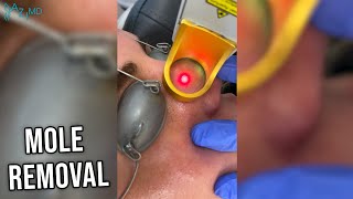 Laser Mole Removal [upl. by Dominique841]