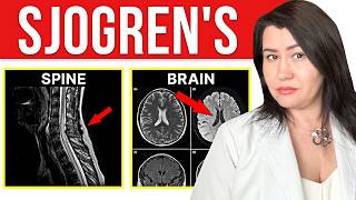 Sjogrens Syndrome Affects the Brain and Spine [upl. by Drahsir]