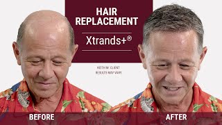 Amazing hair loss solution for men  Hair replacement transformation [upl. by Nnylrefinnej]