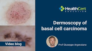 Dermoscopy of basal cell carcinoma  Prof Giuseppe Argenziano [upl. by Cyril]