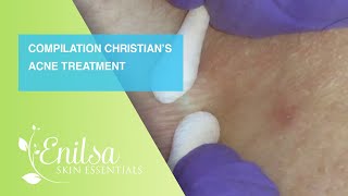 Compilation of Christian’s Acne Treatment [upl. by Waly730]