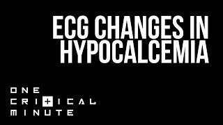 ECG changes in Hypocalcemia  One Critical Minute 1CM [upl. by Alekim122]