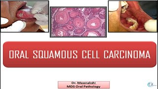 Oral Squamous Cell Carcinoma [upl. by Lianna]