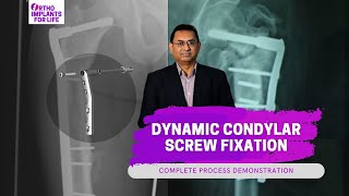 Dynamic Condylar Screw Fixation Procedure [upl. by Whitcomb]