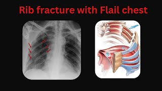 Flail chest  Rib fractue with flail chest Flail chest paradoxical breathing Flail chest managment [upl. by Brainard922]