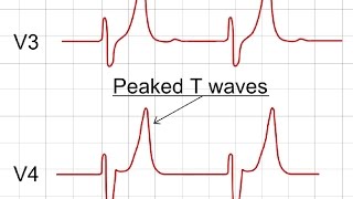 Hyperkalemia on ECG  ECG Findings of Hyperkalemia [upl. by Kandace]