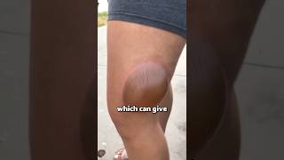 If you see this blister run 😨 viral [upl. by Nosnar]