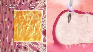 Minimally Invasive Fibroid Ablation – Dr Mitch Dizon [upl. by Beltran37]