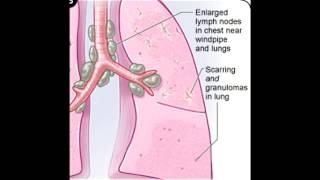 Sarcoidosis Noncaseating Granulomas [upl. by Reider]