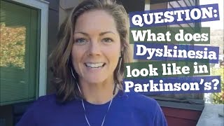 What does dyskinesia look like in Parkinson’s [upl. by Grigson]