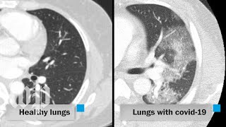 How covid19 attacks the lungs [upl. by Laine389]