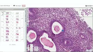 Endometrial Pathology for the Practicing Pathologist by Marisa Rose Nucci MD [upl. by Lav197]