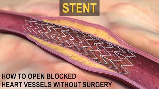 What is a STENT [upl. by Eetsirhc853]