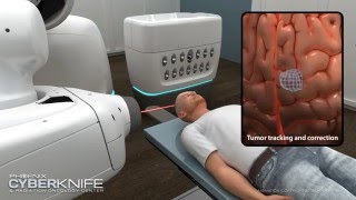 CyberKnife Brain Tumor Animation [upl. by Rese]