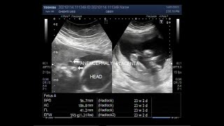 Twins with One Fetal Anencephaly [upl. by Ecnahc256]