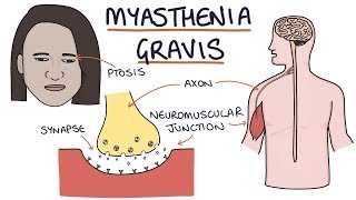 Myasthenia Gravis [upl. by Adli]