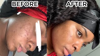 How I Cleared My Skin  Skin Care Routine [upl. by Ellerahc]