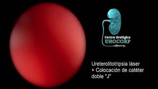 URETEROLITOTRIPSIA LÁSER  COLOCACIÓN DE CATETER DOBLE quotJquot [upl. by Araiet]