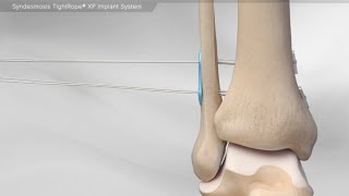 Syndesmosis TightRope® XP Implant System [upl. by Mckee]