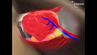 Minimally Invasive Total Thyroidectomy Video [upl. by Jaye241]