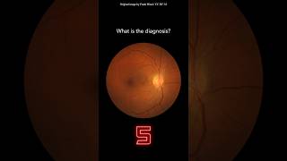 Fundoscopy Question 7 [upl. by Thaddus]