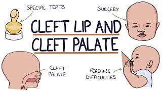 Cleft Lip and Cleft Palate For Students [upl. by Drescher341]