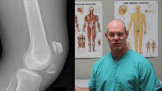 Broken KNEECAP  Fracture Friday Episode 28 [upl. by Assenyl]