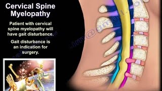 cervical myelopathy and cervical radiculopathy Everything You Need To Know  Dr Nabil Ebraheim [upl. by Igor]