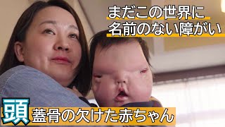 【顔面の形成異常】病名のつかない障がいを持つ赤ちゃんを育てる夫婦に密着 supported by にしたんクリニック にしたんクリニックジャパンバリアフリープロジェクト [upl. by Lemrahs]