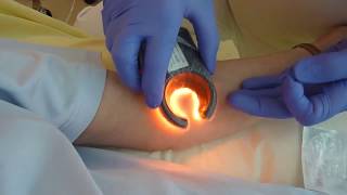 Vein Access with Veinlite LEDX [upl. by Dido]