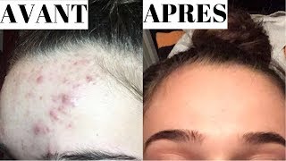 COMMENT SE DEBARRASSER DE LACNE ET MA ROUTINE SOINS  Andie Ella [upl. by Maryanne]