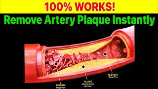 6 Secret Vitamins to Instantly Remove Artery Plaque [upl. by Slade]