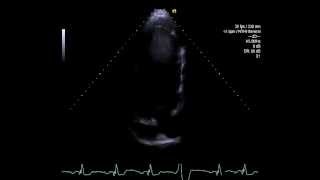 Trombo apical e discinesia com super transdutor de 8 do Simens SC2000 [upl. by Ecreip545]