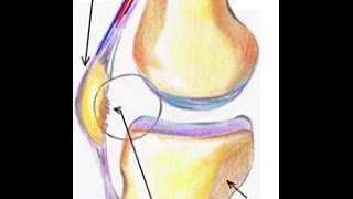 Condromalácia Patelar  Tratamento Completo [upl. by Monsour]