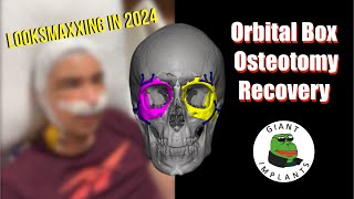 Modified Orbital Box Osteotomy Recovery [upl. by Ardnaiek]