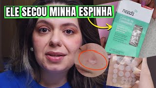 Testei CURATIVO HIDROCOLOIDE PARA ACNE nas minhas Espinhas Marca Needs  Resenha [upl. by Nueormahc]