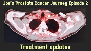 Ep2Prostate Cancer UpdateTreatmentHTSide Effects [upl. by Elwina]