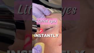 Get lifted eyes instantly with TRL trllaser trending viral medspa trl laser eyes lift [upl. by Balthazar]