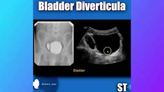 Bladder Diverticulum [upl. by Lundgren]