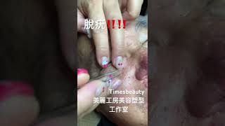 脫疣‼️必須清理‼️timesbeauty ￼美麗工房美容塑型工作室￼￼ [upl. by Miculek]