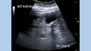 Renal cortical cyst Bosniak type 2F  ultrasound and color Doppler video [upl. by Akenit]