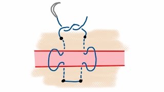 Horizontal mattress suture filmed through GoogleGlass [upl. by Ruscher]