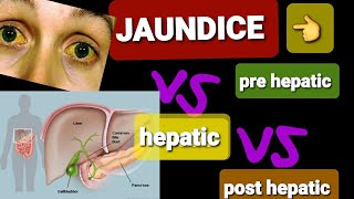 JAUNDICE  PRE HEPATIC VS POST HEPATIC JAUNDICE  DR SHAHRUKH [upl. by Freyah457]