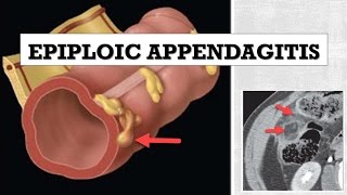 Epiploic Appendagitis [upl. by Alyos]