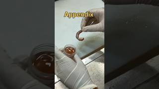 Appendicitis specimen [upl. by Araj427]