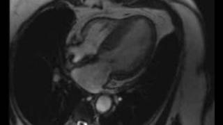 Cardiac MRI  Severe hypertrophic obstructive cardiomyopathy [upl. by Olwen]