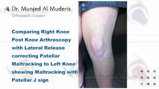 Comparing Right Knee Post Knee Arthroscopy to Left Knee showing Maltracking with Patellar JSign [upl. by Anawd707]