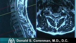 How to Read a MRI of Cervical Nerve Compression  Neck Pain  Colorado Spine Surgeon [upl. by Olympia]